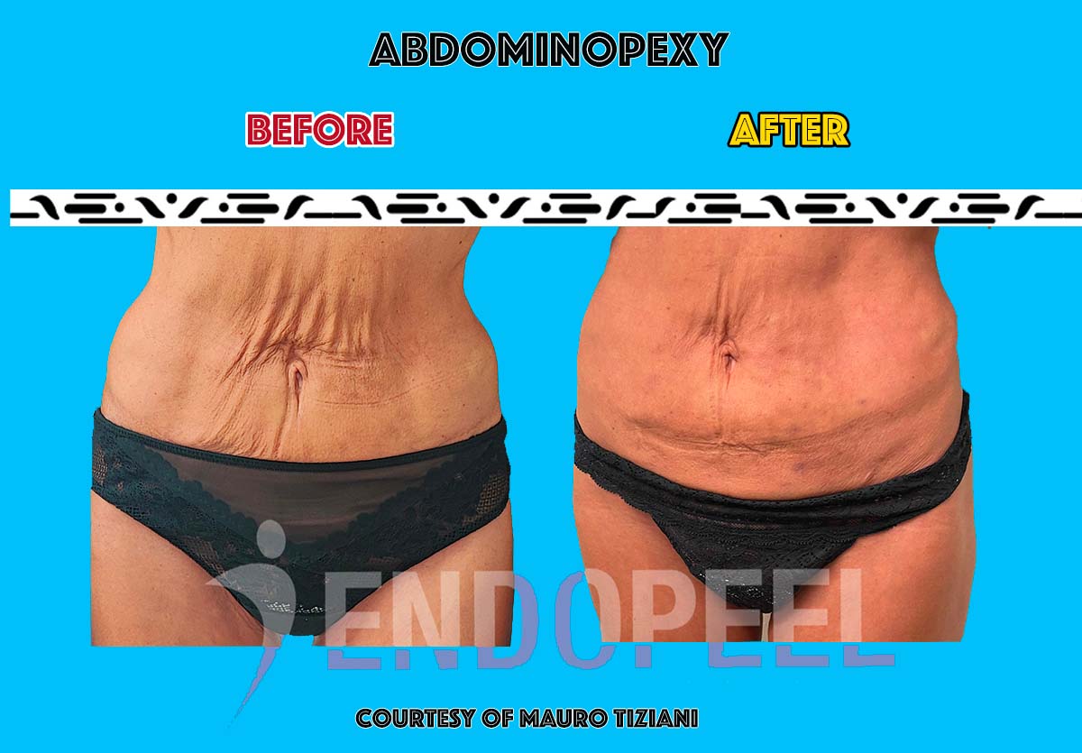 female abdominopexy 1st session