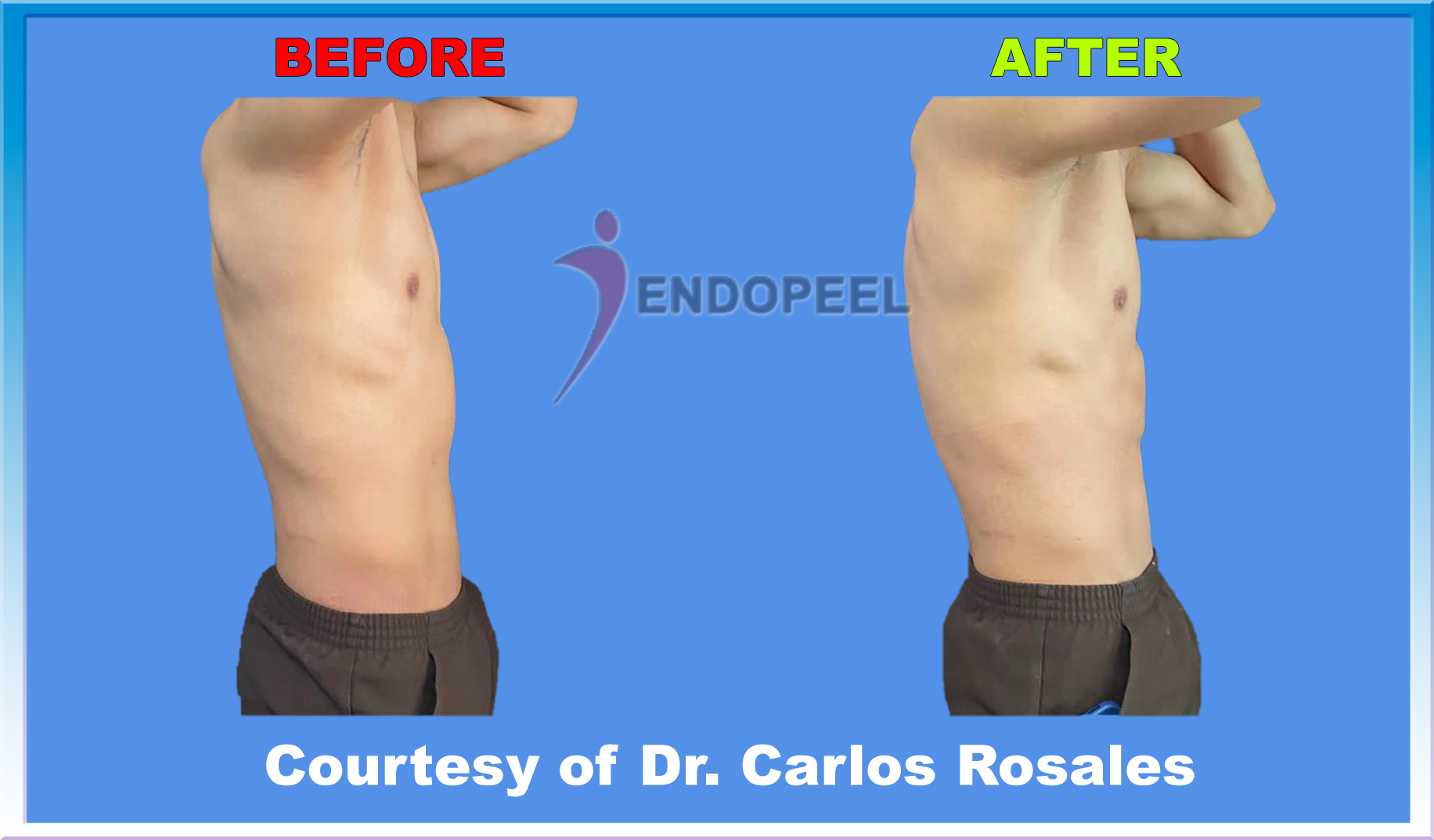 immediate 6 packs endopeel by Dr.Rosales profile view