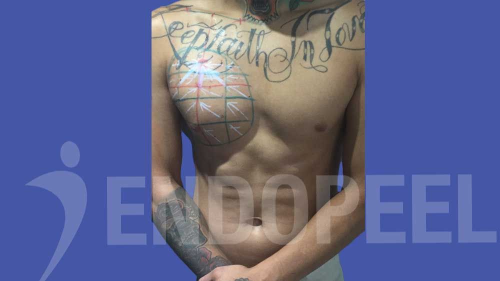 right male endopeel pectoroplasty
