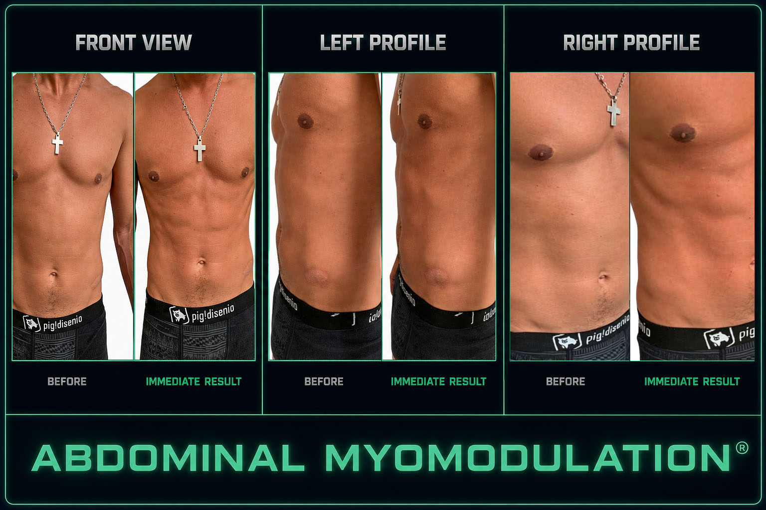 Clinical abdominal myomodulation comparison shown in front and profile views
